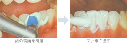 歯の表面を研磨→フッ素の塗布